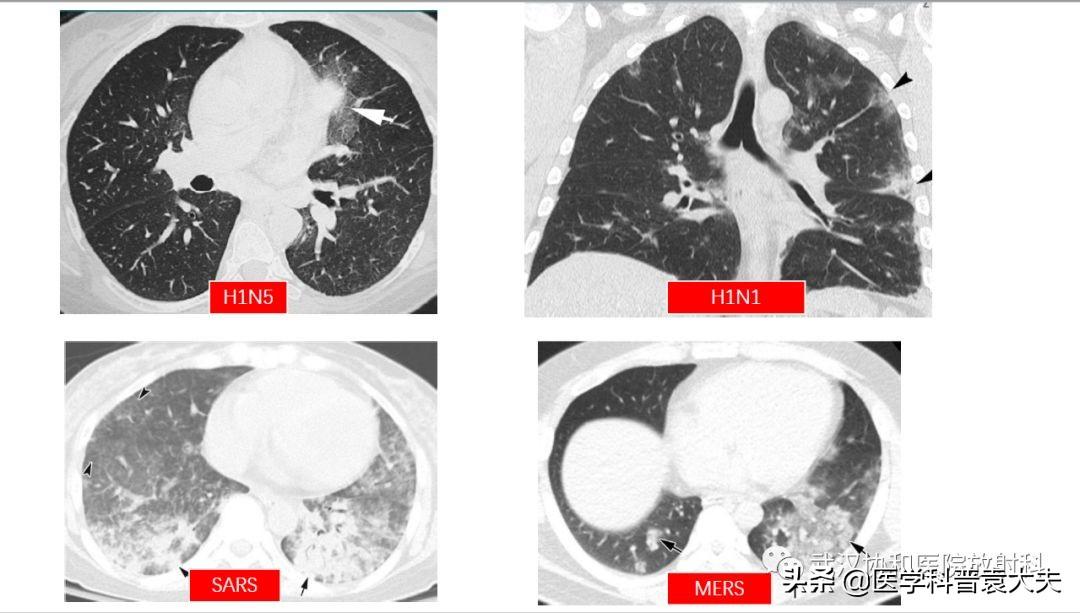 新冠状肺炎最新动态消息