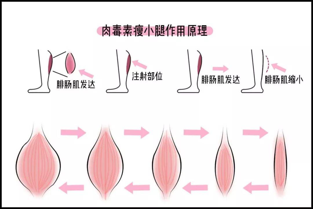 溶脂针最新版